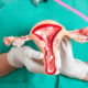 Cáncer de ovario en mujeres