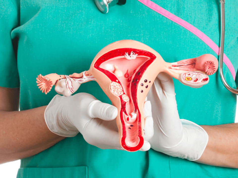 Cáncer de ovario en mujeres